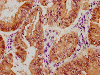 IHC image of RAC07664 diluted at 1:100 and staining in paraffin-embedded human endometrial cancer performed on a Leica BondTM system. After dewaxing and hydration, antigen retrieval was mediated by high pressure in a citrate buffer (pH 6.0). Section was blocked with 10% normal goat serum 30min at RT. Then primary antibody (1% BSA) was incubated at 4? overnight. The primary is detected by a biotinylated secondary antibody and visualized using an HRP conjugated SP system.