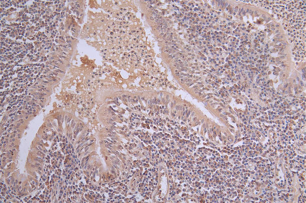 IHC image of RAC07667 diluted at 1:50 and staining in paraffin-embedded human lung tissue performed on a Leica BondTM system. After dewaxing and hydration, antigen retrieval was mediated by high pressure in a citrate buffer (pH 6.0). Section was blocked with 10% normal goat serum 30min at RT. Then primary antibody (1% BSA) was incubated at 4Â°C overnight. The primary is detected by a Goat anti-rabbit polymer IgG labeled by HRP and visualized using 0.63% DAB.