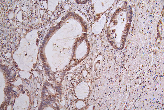 IHC image of RAC07667 diluted at 1:50 and staining in paraffin-embedded human rectal cancer performed on a Leica BondTM system. After dewaxing and hydration, antigen retrieval was mediated by high pressure in a citrate buffer (pH 6.0). Section was blocked with 10% normal goat serum 30min at RT. Then primary antibody (1% BSA) was incubated at 4Â°C overnight. The primary is detected by a Goat anti-rabbit polymer IgG labeled by HRP and visualized using 0.63% DAB.