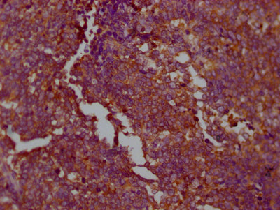 IHC image of RAC07671 diluted at 1:100 and staining in paraffin-embedded human lung cancer performed on a Leica BondTM system. After dewaxing and hydration, antigen retrieval was mediated by high pressure in a citrate buffer (pH 6.0). Section was blocked with 10% normal goat serum 30min at RT. Then primary antibody (1% BSA) was incubated at 4? overnight. The primary is detected by a Goat anti-rabbit IgG polymer labeled by HRP and visualized using 0.05% DAB.