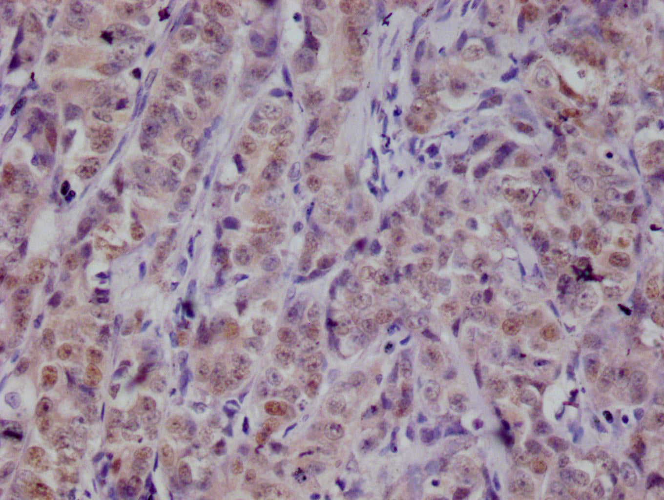 IHC image of RAC07672 diluted at 1:100 and staining in paraffin-embedded human colon cancer performed on a Leica BondTM system. After dewaxing and hydration, antigen retrieval was mediated by high pressure in a citrate buffer (pH 6.0). Section was blocked with 10% normal goat serum 30min at RT. Then primary antibody (1% BSA) was incubated at 4Â°C overnight. The primary is detected by a Goat anti-rabbit polymer IgG labeled by HRP and visualized using 0.05% DAB.