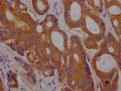 IHC image of RAC07676 diluted at 1:100 and staining in paraffin-embedded human colon cancer performed on a Leica BondTM system. After dewaxing and hydration, antigen retrieval was mediated by high pressure in a citrate buffer (pH 6.0). Section was blocked with 10% normal goat serum 30min at RT. Then primary antibody (1% BSA) was incubated at 4? overnight. The primary is detected by a Goat anti-rabbit IgG polymer labeled by HRP and visualized using 0.05% DAB.