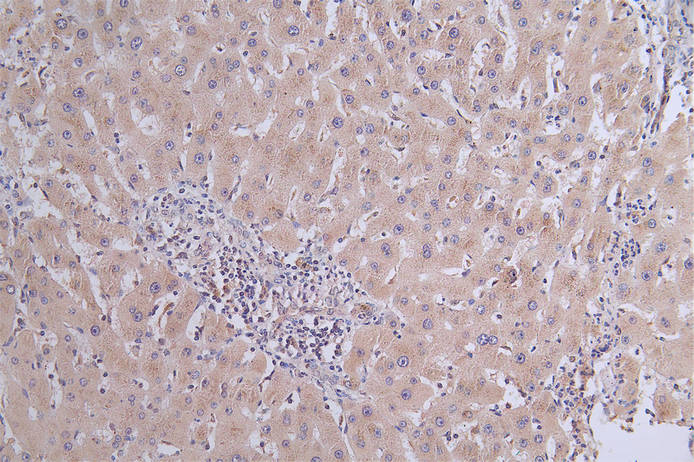 IHC image of RAC07678 diluted at 1:50 and staining in paraffin-embedded human liver cancer performed on a Leica BondTM system. After dewaxing and hydration, antigen retrieval was mediated by high pressure in a citrate buffer (pH 6.0). Section was blocked with 10% normal goat serum 30min at RT. Then primary antibody (1% BSA) was incubated at 4Â°C overnight. The primary is detected by a Goat anti-rabbit polymer IgG labeled by HRP and visualized using 0.31% DAB.