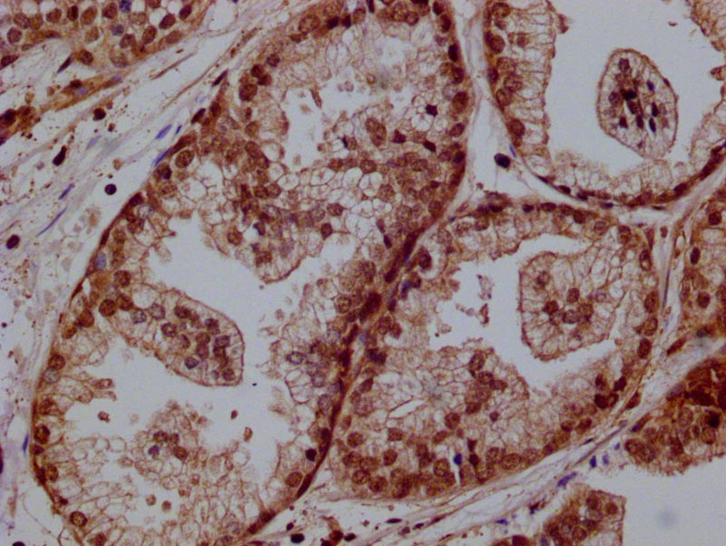 IHC image of RAC07681 diluted at 1:100 and staining in paraffin-embedded human Prostate cancer performed on a Leica BondTM system. After dewaxing and hydration, antigen retrieval was mediated by high pressure in a citrate buffer (pH 6.0). Section was blocked with 10% normal goat serum 30min at RT. Then primary antibody (1% BSA) was incubated at 4Â°C overnight. The primary is detected by a Goat anti-rabbit polymer IgG labeled by HRP and visualized using 0.05% DAB.