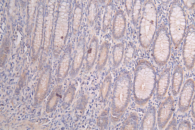 IHC image of RAC07683 diluted at 1:50 and staining in paraffin-embedded human rectal cancer performed on a Leica BondTM system. After dewaxing and hydration, antigen retrieval was mediated by high pressure in a citrate buffer (pH 6.0). Section was blocked with 10% normal goat serum 30min at RT. Then primary antibody (1% BSA) was incubated at 4Â°C overnight. The primary is detected by a Goat anti-rabbit polymer IgG labeled by HRP and visualized using 0.47% DAB.