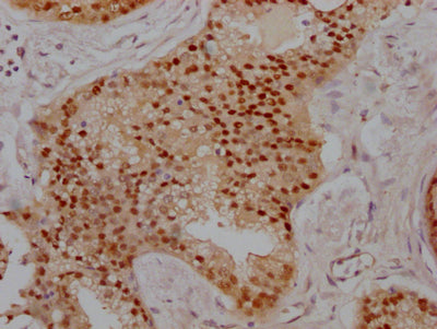 IHC image of RAC07684 diluted at 1:100 and staining in paraffin-embedded human prostate cancer performed on a Leica BondTM system. After dewaxing and hydration, antigen retrieval was mediated by high pressure in a citrate buffer (pH 6.0). Section was blocked with 10% normal goat serum 30min at RT. Then primary antibody (1% BSA) was incubated at 4? overnight. The primary is detected by a Goat anti-rabbit IgG polymer labeled by HRP and visualized using 0.05% DAB.