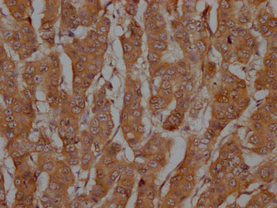 IHC image of RAC07685 diluted at 1:100 and staining in paraffin-embedded human breast cancer performed on a Leica BondTM system. After dewaxing and hydration, antigen retrieval was mediated by high pressure in a citrate buffer (pH 6.0). Section was blocked with 10% normal goat serum 30min at RT. Then primary antibody (1% BSA) was incubated at 4? overnight. The primary is detected by a Goat anti-rabbit IgG polymer labeled by HRP and visualized using 0.05% DAB.