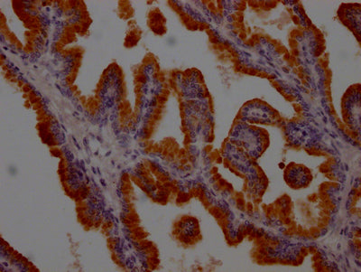 IHC image of RAC07689 diluted at 1:100 and staining in paraffin-embedded human prostate tissue performed on a Leica BondTM system. After dewaxing and hydration, antigen retrieval was mediated by high pressure in a citrate buffer (pH 6.0). Section was blocked with 10% normal goat serum 30min at RT. Then primary antibody (1% BSA) was incubated at 4? overnight. The primary is detected by a Goat anti-rabbit IgG polymer labeled by HRP and visualized using 0.05% DAB.
