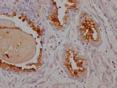 IHC image of RAC07691 diluted at 1:100 and staining in paraffin-embedded human prostate cancer performed on a Leica BondTM system. After dewaxing and hydration, antigen retrieval was mediated by high pressure in a citrate buffer (pH 6.0). Section was blocked with 10% normal goat serum 30min at RT. Then primary antibody (1% BSA) was incubated at 4? overnight. The primary is detected by a Goat anti-rabbit IgG polymer labeled by HRP and visualized using 0.05% DAB.
