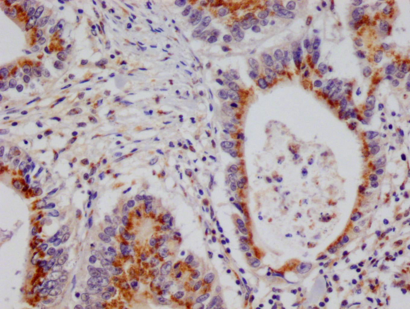 IHC image of RAC07692 diluted at 1:100 and staining in paraffin-embedded human colon cancer performed on a Leica BondTM system. After dewaxing and hydration, antigen retrieval was mediated by high pressure in a citrate buffer (pH 6.0). Section was blocked with 10% normal goat serum 30min at RT. Then primary antibody (1% BSA) was incubated at 4Â°C overnight. The primary is detected by a Goat anti-rabbit polymer IgG labeled by HRP and visualized using 0.05% DAB.