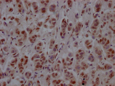 IHC image of RAC07693 diluted at 1:100 and staining in paraffin-embedded human breast cancer performed on a Leica BondTM system. After dewaxing and hydration, antigen retrieval was mediated by high pressure in a citrate buffer (pH 6.0). Section was blocked with 10% normal goat serum 30min at RT. Then primary antibody (1% BSA) was incubated at 4? overnight. The primary is detected by a Goat anti-rabbit IgG polymer labeled by HRP and visualized using 0.05% DAB.