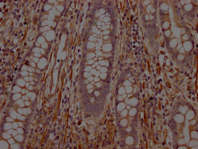 IHC image of RAC07696 diluted at 1:100 and staining in paraffin-embedded human colon cancer performed on a Leica BondTM system. After dewaxing and hydration, antigen retrieval was mediated by high pressure in a citrate buffer (pH 6.0). Section was blocked with 10% normal goat serum 30min at RT. Then primary antibody (1% BSA) was incubated at 4? overnight. The primary is detected by a Goat anti-rabbit IgG polymer labeled by HRP and visualized using 0.05% DAB.