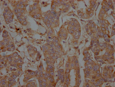 IHC image of RAC07696 diluted at 1:100 and staining in paraffin-embedded human breast cancer performed on a Leica BondTM system. After dewaxing and hydration, antigen retrieval was mediated by high pressure in a citrate buffer (pH 6.0). Section was blocked with 10% normal goat serum 30min at RT. Then primary antibody (1% BSA) was incubated at 4? overnight. The primary is detected by a Goat anti-rabbit IgG polymer labeled by HRP and visualized using 0.05% DAB.