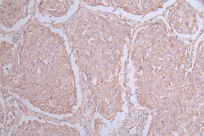 IHC image of RAC07698 diluted at 1:50 and staining in paraffin-embedded human lung cancer performed on a Leica BondTM system. After dewaxing and hydration, antigen retrieval was mediated by high pressure in a citrate buffer (pH 6.0). Section was blocked with 10% normal goat serum 30min at RT. Then primary antibody (1% BSA) was incubated at 4Â°C overnight. The primary is detected by a Goat anti-rabbit polymer IgG labeled by HRP and visualized using 0.42% DAB.