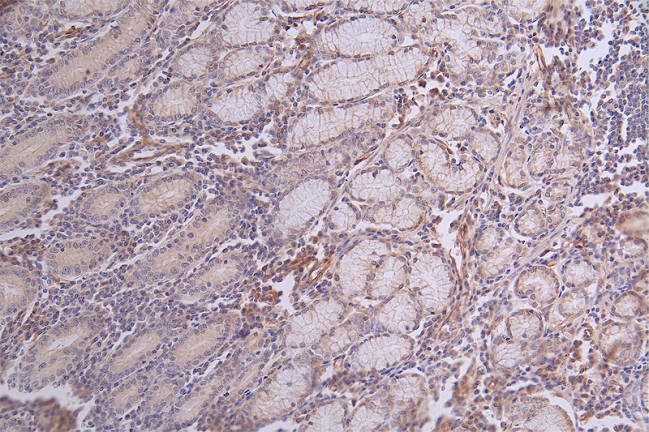 IHC image of RAC07700 diluted at 1:50 and staining in paraffin-embedded human breast cancer performed on a Leica BondTM system. After dewaxing and hydration, antigen retrieval was mediated by high pressure in a citrate buffer (pH 6.0). Section was blocked with 10% normal goat serum 30min at RT. Then primary antibody (1% BSA) was incubated at 4Â°C overnight. The primary is detected by a Goat anti-rabbit polymer IgG labeled by HRP and visualized using 0.62% DAB.