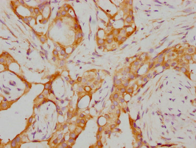 IHC image of RAC07705 diluted at 1:155 and staining in paraffin-embedded human breast cancer performed on a Leica BondTM system. After dewaxing and hydration, antigen retrieval was mediated by high pressure in a citrate buffer (pH 6.0). Section was blocked with 10% normal goat serum 30min at RT. Then primary antibody (1% BSA) was incubated at 4? overnight. The primary is detected by a biotinylated secondary antibody and visualized using an HRP conjugated SP system.