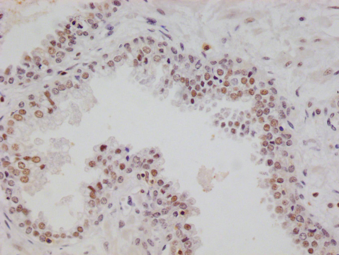 IHC image of RAC07710 diluted at 1:100 and staining in paraffin-embedded human prostate cancer performed on a Leica BondTM system. After dewaxing and hydration, antigen retrieval was mediated by high pressure in a citrate buffer (pH 6.0). Section was blocked with 10% normal goat serum 30min at RT. Then primary antibody (1% BSA) was incubated at 4Â°C overnight. The primary is detected by a Goat anti-rabbit polymer IgG labeled by HRP and visualized using 0.05% DAB.