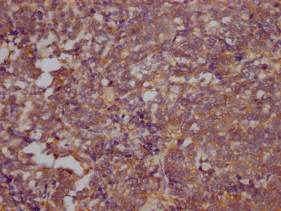 IHC image of RAC07713 diluted at 1:100 and staining in paraffin-embedded human lung cancer performed on a Leica BondTM system. After dewaxing and hydration, antigen retrieval was mediated by high pressure in a citrate buffer (pH 6.0). Section was blocked with 10% normal goat serum 30min at RT. Then primary antibody (1% BSA) was incubated at 4? overnight. The primary is detected by a Goat anti-rabbit IgG polymer labeled by HRP and visualized using 0.05% DAB.