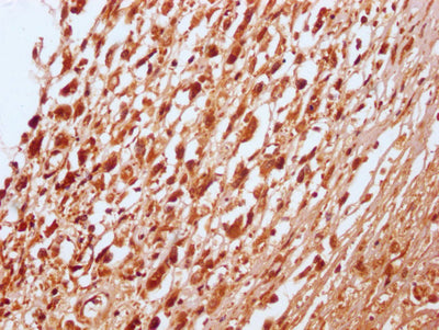IHC image of RAC07715 diluted at 1:100 and staining in paraffin-embedded human melanoma cancer performed on a Leica BondTM system. After dewaxing and hydration, antigen retrieval was mediated by high pressure in a citrate buffer (pH 6.0). Section was blocked with 10% normal goat serum 30min at RT. Then primary antibody (1% BSA) was incubated at 4? overnight. The primary is detected by a Goat anti-rabbit IgG polymer labeled by HRP and visualized using 0.05% DAB.