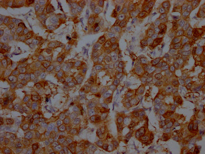IHC image of RAC07719 diluted at 1:100 and staining in paraffin-embedded human breast cancer performed on a Leica BondTM system. After dewaxing and hydration, antigen retrieval was mediated by high pressure in a citrate buffer (pH 6.0). Section was blocked with 10% normal goat serum 30min at RT. Then primary antibody (1% BSA) was incubated at 4? overnight. The primary is detected by a Goat anti-rabbit IgG polymer labeled by HRP and visualized using 0.05% DAB.