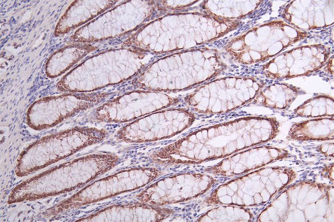 IHC image of RAC07724 diluted at 1:50 and staining in paraffin-embedded human rectal cancer performed on a Leica BondTM system. After dewaxing and hydration, antigen retrieval was mediated by high pressure in a citrate buffer (pH 6.0). Section was blocked with 10% normal goat serum 30min at RT. Then primary antibody (1% BSA) was incubated at 4Â°C overnight. The primary is detected by a Goat anti-rabbit polymer IgG labeled by HRP and visualized using 0.68% DAB.