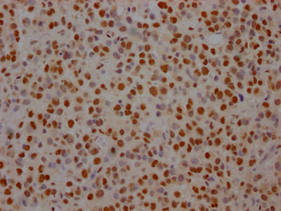 IHC image of RAC07731 diluted at 1:100 and staining in paraffin-embedded human glioma cancer performed on a Leica BondTM system. After dewaxing and hydration, antigen retrieval was mediated by high pressure in a citrate buffer (pH 6.0). Section was blocked with 10% normal goat serum 30min at RT. Then primary antibody (1% BSA) was incubated at 4? overnight. The primary is detected by a Goat anti-rabbit IgG polymer labeled by HRP and visualized using 0.05% DAB.