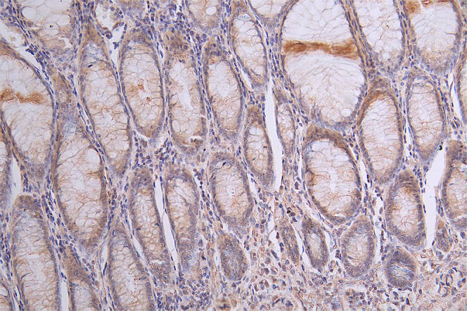 IHC image of RAC07735 diluted at 1:50 and staining in paraffin-embedded human rectal cancer performed on a Leica BondTM system. After dewaxing and hydration, antigen retrieval was mediated by high pressure in a citrate buffer (pH 6.0). Section was blocked with 10% normal goat serum 30min at RT. Then primary antibody (1% BSA) was incubated at 4Â°C overnight. The primary is detected by a Goat anti-rabbit polymer IgG labeled by HRP and visualized using 0.13% DAB.