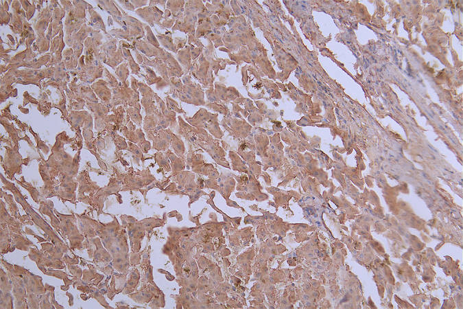 IHC image of RAC07743 diluted at 1:50 and staining in paraffin-embedded human liver cancer performed on a Leica BondTM system. After dewaxing and hydration, antigen retrieval was mediated by high pressure in a citrate buffer (pH 6.0). Section was blocked with 10% normal goat serum 30min at RT. Then primary antibody (1% BSA) was incubated at 4Â°C overnight. The primary is detected by a Goat anti-rabbit polymer IgG labeled by HRP and visualized using 0.20% DAB.