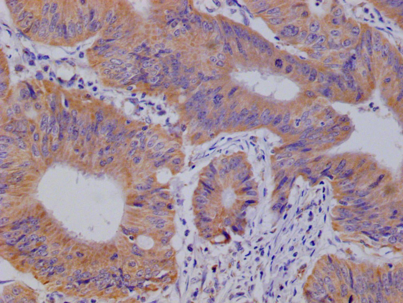 IHC image of RAC07744 diluted at 1:100 and staining in paraffin-embedded human colon cancer performed on a Leica BondTM system. After dewaxing and hydration, antigen retrieval was mediated by high pressure in a citrate buffer (pH 6.0). Section was blocked with 10% normal goat serum 30min at RT. Then primary antibody (1% BSA) was incubated at 4Â°C overnight. The primary is detected by a Goat anti-rabbit polymer IgG labeled by HRP and visualized using 0.05% DAB.