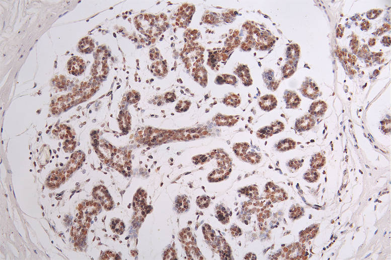 IHC image of RAC07746 diluted at 1:50 and staining in paraffin-embedded human breast cancer performed on a Leica BondTM system. After dewaxing and hydration, antigen retrieval was mediated by high pressure in a citrate buffer (pH 6.0). Section was blocked with 10% normal goat serum 30min at RT. Then primary antibody (1% BSA) was incubated at 4Â°C overnight. The primary is detected by a Goat anti-rabbit polymer IgG labeled by HRP and visualized using 0.44% DAB.