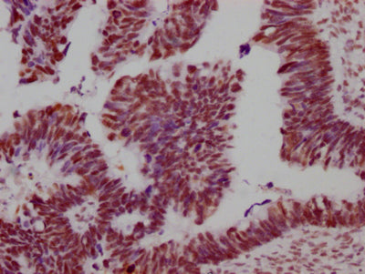 IHC image of RAC07747 diluted at 1:100 and staining in paraffin-embedded human ovarian cancer performed on a Leica BondTM system. After dewaxing and hydration, antigen retrieval was mediated by high pressure in a citrate buffer (pH 6.0). Section was blocked with 10% normal goat serum 30min at RT. Then primary antibody (1% BSA) was incubated at 4? overnight. The primary is detected by a Goat anti-rabbit IgG polymer labeled by HRP and visualized using 0.05% DAB.