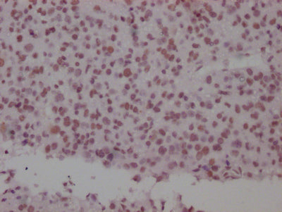 IHC image of RAC07747 diluted at 1:100 and staining in paraffin-embedded human glioma cancer performed on a Leica BondTM system. After dewaxing and hydration, antigen retrieval was mediated by high pressure in a citrate buffer (pH 6.0). Section was blocked with 10% normal goat serum 30min at RT. Then primary antibody (1% BSA) was incubated at 4? overnight. The primary is detected by a Goat anti-rabbit IgG polymer labeled by HRP and visualized using 0.05% DAB.