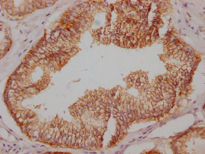 IHC image of RAC07749 diluted at 1:100 and staining in paraffin-embedded human prostate cancer performed on a Leica BondTM system. After dewaxing and hydration, antigen retrieval was mediated by high pressure in a citrate buffer (pH 6.0). Section was blocked with 10% normal goat serum 30min at RT. Then primary antibody (1% BSA) was incubated at 4? overnight. The primary is detected by a Goat anti-rabbit IgG polymer labeled by HRP and visualized using 0.05% DAB.