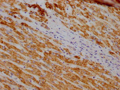 IHC image of RAC07752 diluted at 1:100 and staining in paraffin-embedded human liver cancer performed on a Leica BondTM system. After dewaxing and hydration, antigen retrieval was mediated by high pressure in a citrate buffer (pH 6.0). Section was blocked with 10% normal goat serum 30min at RT. Then primary antibody (1% BSA) was incubated at 4? overnight. The primary is detected by a Goat anti-rabbit IgG polymer labeled by HRP and visualized using 0.05% DAB.