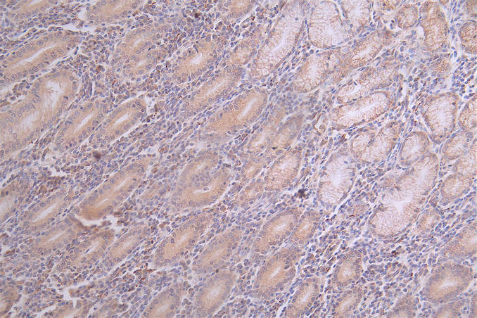 IHC image of RAC07753 diluted at 1:100 and staining in paraffin-embedded human breast cancer performed on a Leica BondTM system. After dewaxing and hydration, antigen retrieval was mediated by high pressure in a citrate buffer (pH 6.0). Section was blocked with 10% normal goat serum 30min at RT. Then primary antibody (1% BSA) was incubated at 4Â°C overnight. The primary is detected by a Goat anti-rabbit polymer IgG labeled by HRP and visualized using 0.69% DAB.