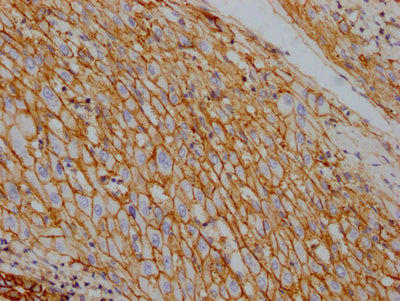 IHC image of RAC07754 diluted at 1:100 and staining in paraffin-embedded human liver cancer performed on a Leica BondTM system. After dewaxing and hydration, antigen retrieval was mediated by high pressure in a citrate buffer (pH 6.0). Section was blocked with 10% normal goat serum 30min at RT. Then primary antibody (1% BSA) was incubated at 4? overnight. The primary is detected by a Goat anti-rabbit IgG polymer labeled by HRP and visualized using 0.05% DAB.