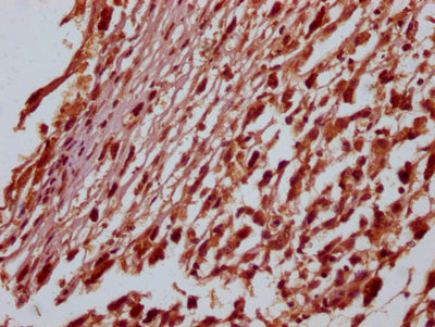 IHC image of RAC07757 diluted at 1:100 and staining in paraffin-embedded human melanoma cancer performed on a Leica BondTM system. After dewaxing and hydration, antigen retrieval was mediated by high pressure in a citrate buffer (pH 6.0). Section was blocked with 10% normal goat serum 30min at RT. Then primary antibody (1% BSA) was incubated at 4? overnight. The primary is detected by a Goat anti-rabbit IgG polymer labeled by HRP and visualized using 0.05% DAB.