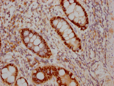 IHC image of RAC07758 diluted at 1:100 and staining in paraffin-embedded human colon cancer performed on a Leica BondTM system. After dewaxing and hydration, antigen retrieval was mediated by high pressure in a citrate buffer (pH 6.0). Section was blocked with 10% normal goat serum 30min at RT. Then primary antibody (1% BSA) was incubated at 4? overnight. The primary is detected by a Goat anti-rabbit IgG polymer labeled by HRP and visualized using 0.05% DAB.
