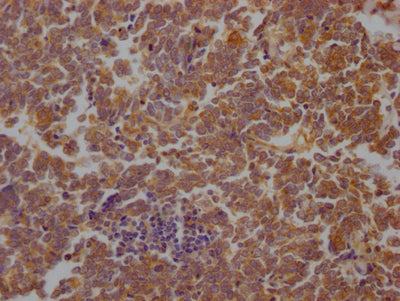 IHC image of RAC07763 diluted at 1:100 and staining in paraffin-embedded human lung cancer performed on a Leica BondTM system. After dewaxing and hydration, antigen retrieval was mediated by high pressure in a citrate buffer (pH 6.0). Section was blocked with 10% normal goat serum 30min at RT. Then primary antibody (1% BSA) was incubated at 4? overnight. The primary is detected by a Goat anti-rabbit IgG polymer labeled by HRP and visualized using 0.05% DAB.