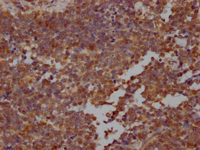 IHC image of RAC07764 diluted at 1:100 and staining in paraffin-embedded human lung cancer performed on a Leica BondTM system. After dewaxing and hydration, antigen retrieval was mediated by high pressure in a citrate buffer (pH 6.0). Section was blocked with 10% normal goat serum 30min at RT. Then primary antibody (1% BSA) was incubated at 4? overnight. The primary is detected by a Goat anti-rabbit IgG polymer labeled by HRP and visualized using 0.05% DAB.