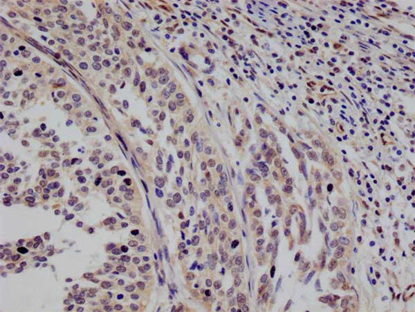 IHC image of RAC07765 diluted at 1:100 and staining in paraffin-embedded human cervical cancer performed on a Leica BondTM system. After dewaxing and hydration, antigen retrieval was mediated by high pressure in a citrate buffer (pH 6.0). Section was blocked with 10% normal goat serum 30min at RT. Then primary antibody (1% BSA) was incubated at 4Â°C overnight. The primary is detected by a Goat anti-rabbit polymer IgG labeled by HRP and visualized using 0.05% DAB.