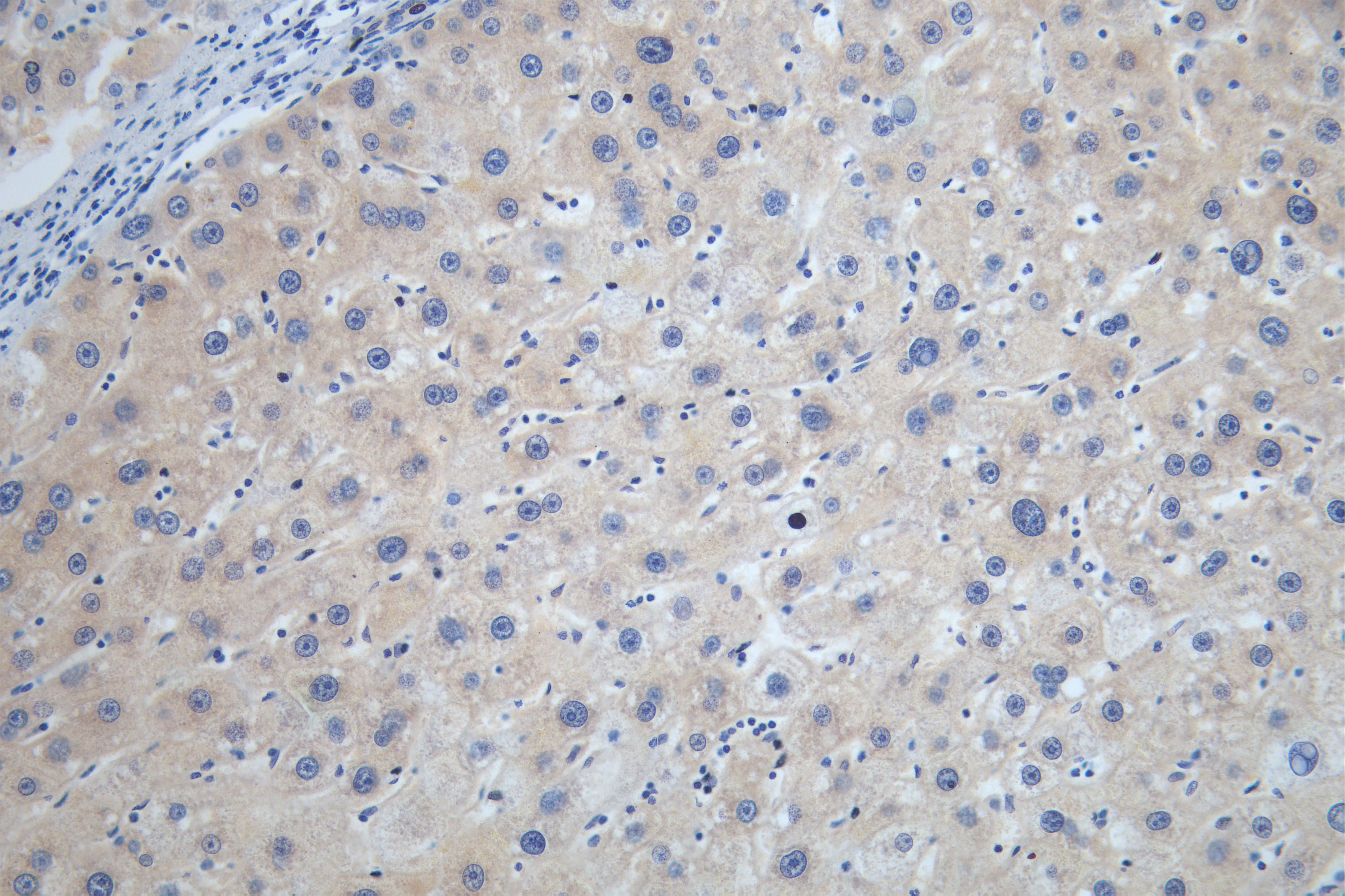 IHC image of RAC07769 diluted at 1:100 and staining in paraffin-embedded human liver cancer performed on a Leica BondTM system. After dewaxing and hydration, antigen retrieval was mediated by high pressure in a citrate buffer (pH 6.0). Section was blocked with 10% normal goat serum 30min at RT. Then primary antibody (1% BSA) was incubated at 4Â°C overnight. The primary is detected by a Goat anti-rabbit polymer IgG labeled by HRP and visualized using 0.05% DAB.