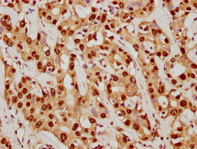 IHC image of RAC07770 diluted at 1:92.5 and staining in paraffin-embedded human liver cancer performed on a Leica BondTM system. After dewaxing and hydration, antigen retrieval was mediated by high pressure in a citrate buffer (pH 6.0). Section was blocked with 10% normal goat serum 30min at RT. Then primary antibody (1% BSA) was incubated at 4? overnight. The primary is detected by a biotinylated secondary antibody and visualized using an HRP conjugated SP system.