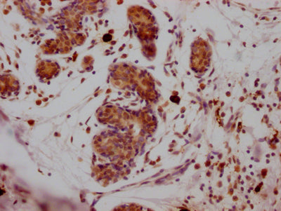 IHC image of RAC07772 diluted at 1:100 and staining in paraffin-embedded human breast cancer performed on a Leica BondTM system. After dewaxing and hydration, antigen retrieval was mediated by high pressure in a citrate buffer (pH 6.0). Section was blocked with 10% normal goat serum 30min at RT. Then primary antibody (1% BSA) was incubated at 4? overnight. The primary is detected by a Goat anti-rabbit IgG polymer labeled by HRP and visualized using 0.05% DAB.