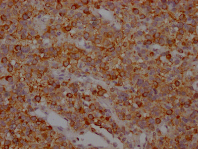 IHC image of RAC07774 diluted at 1:100 and staining in paraffin-embedded human glioma cancer performed on a Leica BondTM system. After dewaxing and hydration, antigen retrieval was mediated by high pressure in a citrate buffer (pH 6.0). Section was blocked with 10% normal goat serum 30min at RT. Then primary antibody (1% BSA) was incubated at 4? overnight. The primary is detected by a Goat anti-rabbit IgG polymer labeled by HRP and visualized using 0.05% DAB.