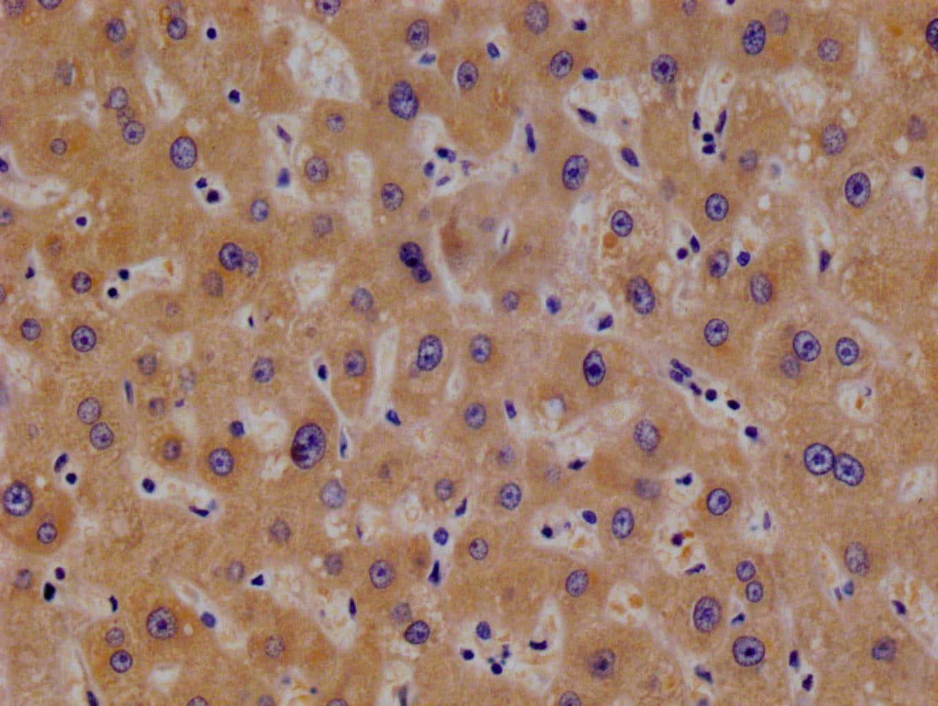 IHC image of RAC07775 diluted at 1:100 and staining in paraffin-embedded human liver cancer performed on a Leica BondTM system. After dewaxing and hydration, antigen retrieval was mediated by high pressure in a citrate buffer (pH 6.0). Section was blocked with 10% normal goat serum 30min at RT. Then primary antibody (1% BSA) was incubated at 4Â°C overnight. The primary is detected by a Goat anti-rabbit polymer IgG labeled by HRP and visualized using 0.05% DAB.