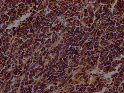 IHC image of RAC07779 diluted at 1:100 and staining in paraffin-embedded human lung cancer performed on a Leica BondTM system. After dewaxing and hydration, antigen retrieval was mediated by high pressure in a citrate buffer (pH 6.0). Section was blocked with 10% normal goat serum 30min at RT. Then primary antibody (1% BSA) was incubated at 4? overnight. The primary is detected by a Goat anti-rabbit IgG polymer labeled by HRP and visualized using 0.05% DAB.