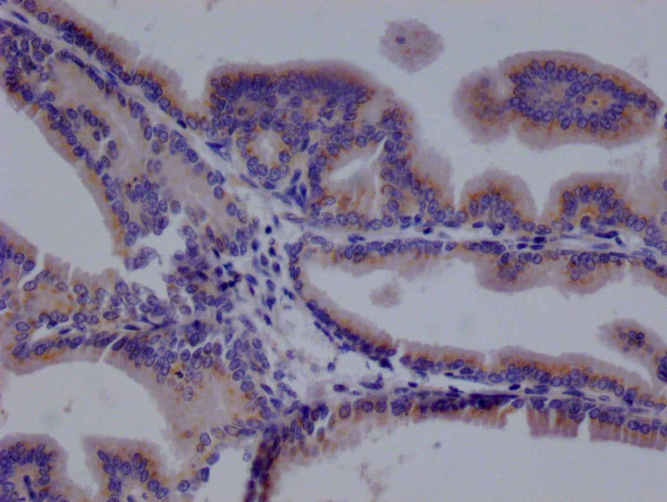 IHC image of RAC07790 diluted at 1:100 and staining in paraffin-embedded human prostate tissue performed on a Leica BondTM system. After dewaxing and hydration, antigen retrieval was mediated by high pressure in a citrate buffer (pH 6.0). Section was blocked with 10% normal goat serum 30min at RT. Then primary antibody (1% BSA) was incubated at 4Â°C overnight. The primary is detected by a Goat anti-rabbit polymer IgG labeled by HRP and visualized using 0.05% DAB.