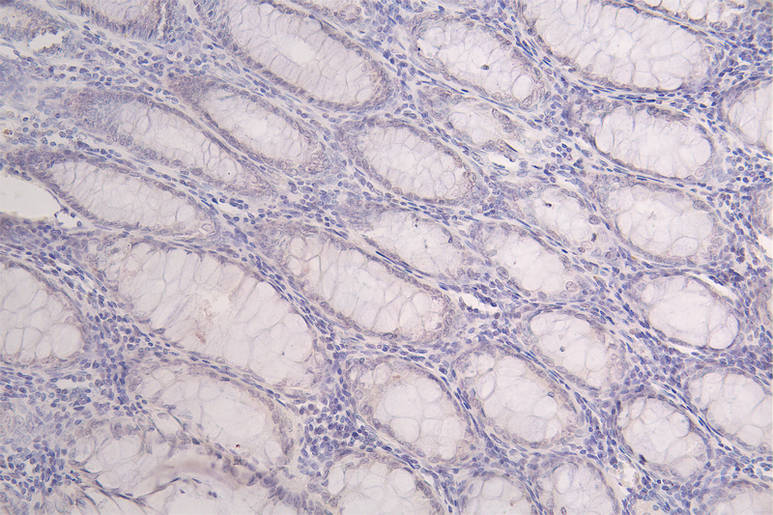 IHC image of RAC07791 diluted at 1:50 and staining in paraffin-embedded human rectal cancer performed on a Leica BondTM system. After dewaxing and hydration, antigen retrieval was mediated by high pressure in a citrate buffer (pH 6.0). Section was blocked with 10% normal goat serum 30min at RT. Then primary antibody (1% BSA) was incubated at 4Â°C overnight. The primary is detected by a Goat anti-rabbit polymer IgG labeled by HRP and visualized using 0.16% DAB.