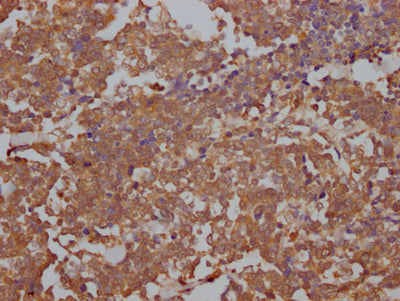 IHC image of RAC07793 diluted at 1:100 and staining in paraffin-embedded human lung cancer performed on a Leica BondTM system. After dewaxing and hydration, antigen retrieval was mediated by high pressure in a citrate buffer (pH 6.0). Section was blocked with 10% normal goat serum 30min at RT. Then primary antibody (1% BSA) was incubated at 4? overnight. The primary is detected by a Goat anti-rabbit IgG polymer labeled by HRP and visualized using 0.05% DAB.